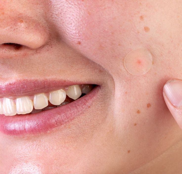 Acne Hydrocolloid Pimple Patches